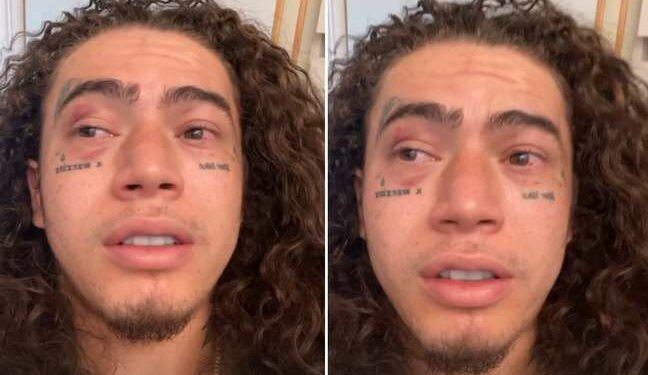 Whindersson Nunes mostra olhos vermelhos após luta com Popó e brinca: “Ele passou conjuntivite”