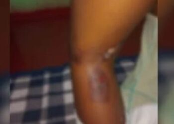 Mãe queima filha de 8 anos com colher de metal por ela comer demais: ‘ela me castigava’