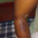 Mãe queima filha de 8 anos com colher de metal por ela comer demais: ‘ela me castigava’