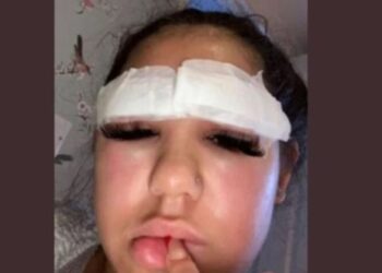 Influenciadora perde sobrancelhas após micropigmentação malsucedida