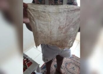 Dona de casa descobre pano dentro do ânus após cesárea