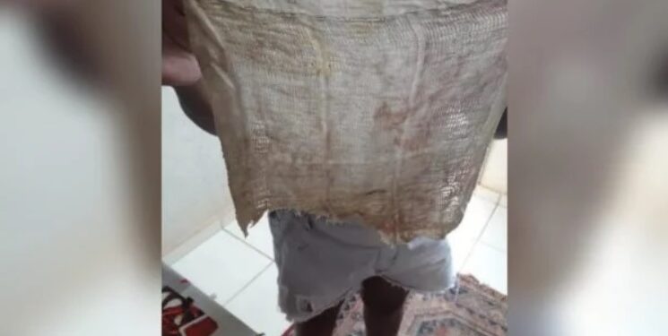 Dona de casa descobre pano dentro do ânus após cesárea