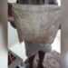 Dona de casa descobre pano dentro do ânus após cesárea
