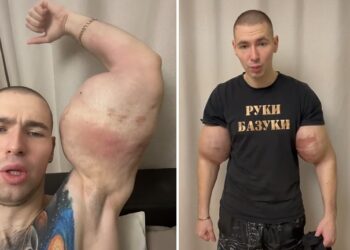 Bizarro: Após injetar vaselina e quase morrer ‘Popeye russo’ volta a exibir braços enormes