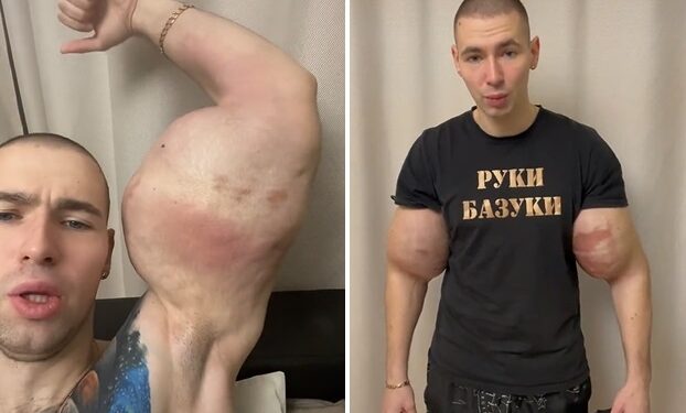 Bizarro: Após injetar vaselina e quase morrer ‘Popeye russo’ volta a exibir braços enormes
