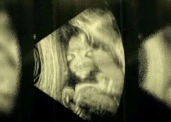 Mãe se assusta durante ultrassom da filha: “bebê demônio”