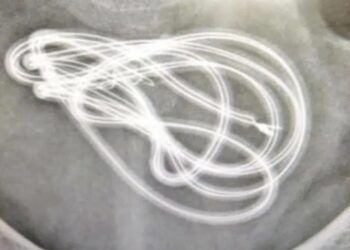 Homem coloca cabo de fone de ouvido em bexiga durante masturbação e vai parar no hospital