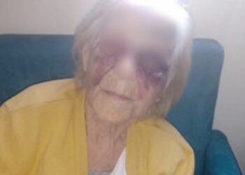 Idosa de 93 anos aparece com o rosto e olhos roxos e suspeita é a própria nora