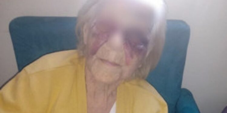 Idosa de 93 anos aparece com o rosto e olhos roxos e suspeita é a própria nora