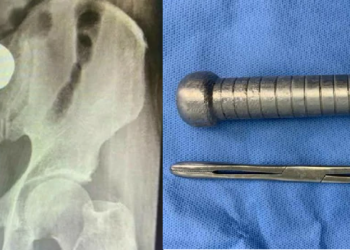 Peso de academia de 2 kg é encontrado por médicos em reto de homem, em Manaus