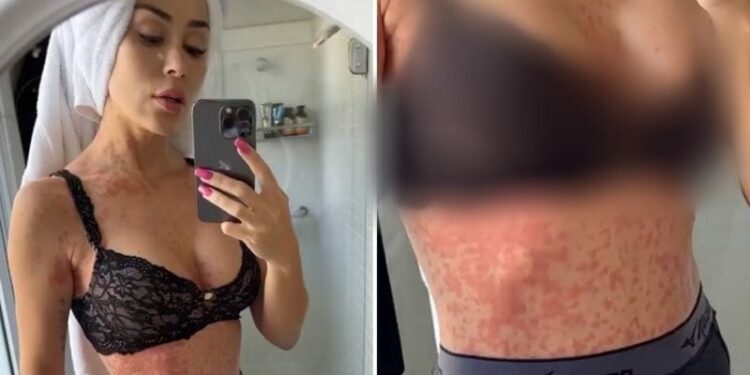 Ex-BBB choca ao mostrar inflamação pelo corpo e não ter diagnóstico do problema