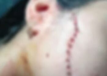 Possuída pelo ciúme, mulher corta o rosto de adolescente no AM