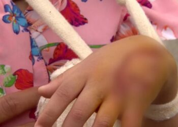 Criança de 4 anos tem mão mutilada em aparelho de raio-x de penitenciária de Manaus