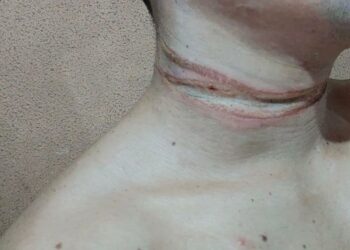 Motociclista fica com o pescoço cortado ao se enrolar em fios soltos de poste no Vieiralves