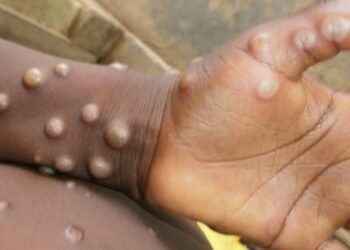 Saúde do Amazonas emite ‘Comunicado de Alerta’ para Varíola de Macacos