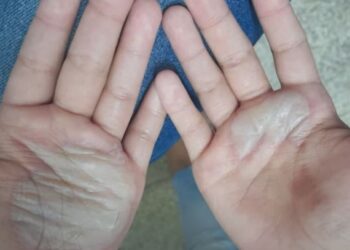 Monstruosidade: mãe queima mãos da filha com colher quente em Manaus