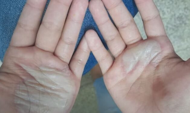 Monstruosidade: mãe queima mãos da filha com colher quente em Manaus