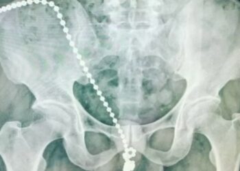 Prazer doloroso: homem passa por cirurgia após introduzir corrente de bolinhas no pênis