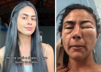 Jovem tem reação alérgica ao comer camarão e fica toda inchada: “Quase morri”
