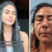 Jovem tem reação alérgica ao comer camarão e fica toda inchada: “Quase morri”