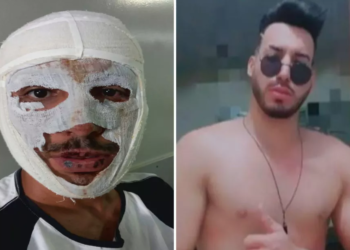 Homem diz que a ex jogou soda cáustica nele por não aceitar fim da relação