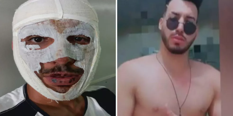 Homem diz que a ex jogou soda cáustica nele por não aceitar fim da relação