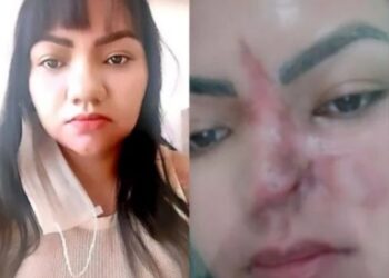 Mulher perde parte do nariz após cirurgia estética com dentista dar errado