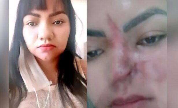 Mulher perde parte do nariz após cirurgia estética com dentista dar errado