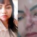 Mulher perde parte do nariz após cirurgia estética com dentista dar errado