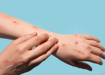 Mais dois casos de varíola dos macacos são investigados no Amazonas