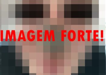 Homem fica com o nariz podre após pegar varíola dos macacos, sífilis e AIDS