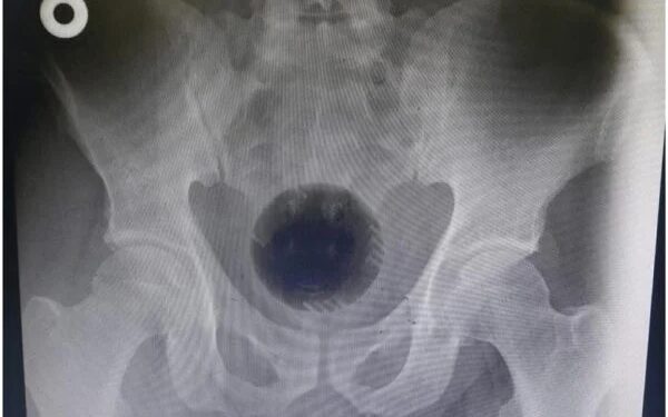 Homem passa por cirurgia para retirar bola de 7 cm presa no furico