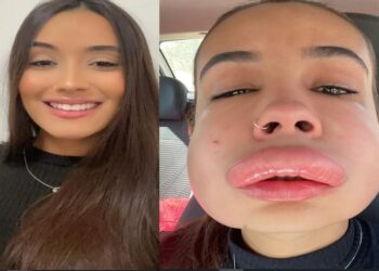 Estudante sofre reação alérgica bizarra ao corrigir preenchimento labial