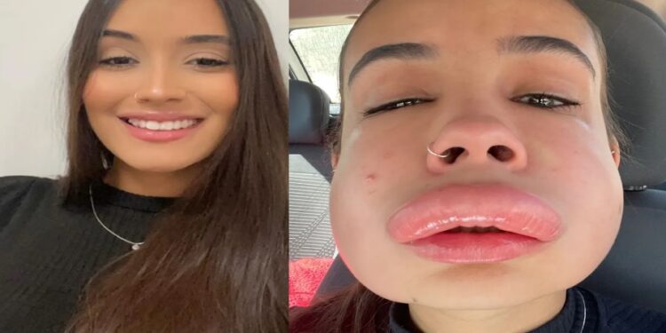 Estudante sofre reação alérgica bizarra ao corrigir preenchimento labial