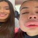 Estudante sofre reação alérgica bizarra ao corrigir preenchimento labial