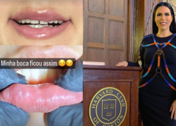 Jornalista diz que ficou com a boca deformada após procedimento com famosa dentista de Manaus