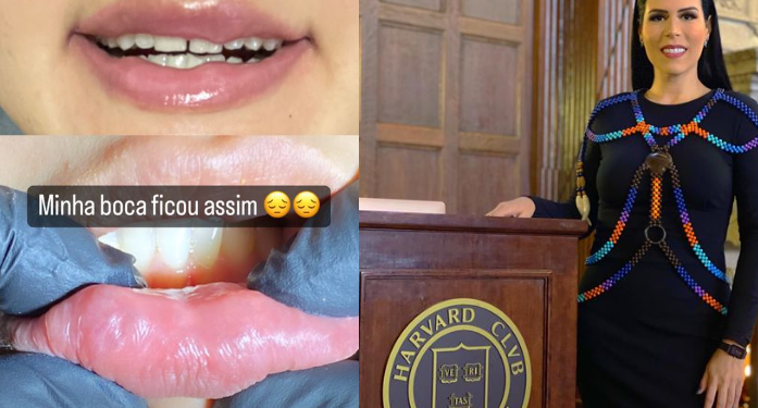 Jornalista diz que ficou com a boca deformada após procedimento com famosa dentista de Manaus