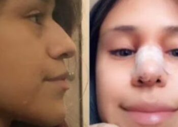 Revanche: Tiktoker descobre traição do namorado e o obriga a pagar rinoplastia dela como ‘perdão’