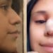 Revanche: Tiktoker descobre traição do namorado e o obriga a pagar rinoplastia dela como ‘perdão’