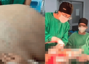 Médicos fazem cirurgia de emergência e retiram tumor de 46kg de paciente
