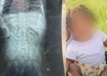 No Pará, garotinha engole prego no dia do aniversário de 1 ano