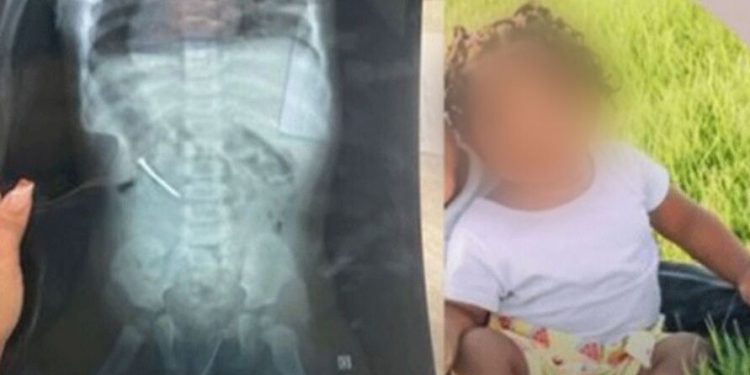 No Pará, garotinha engole prego no dia do aniversário de 1 ano