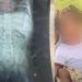 No Pará, garotinha engole prego no dia do aniversário de 1 ano