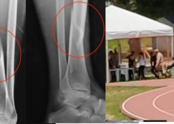 Em Manaus, candidata quebra as pernas durante teste físico de concurso