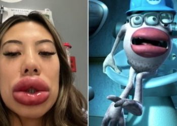 Jovem viraliza na internet ao aparecer com lábios desfigurados