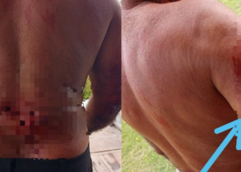 Vídeo: Homem é atacado por jacaré no AM e fica com parte do braço e costas dilacerados