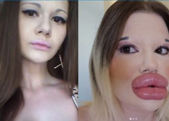 ‘Barbie humana’ corre risco de morrer após realizar preenchimento labial 32 vezes