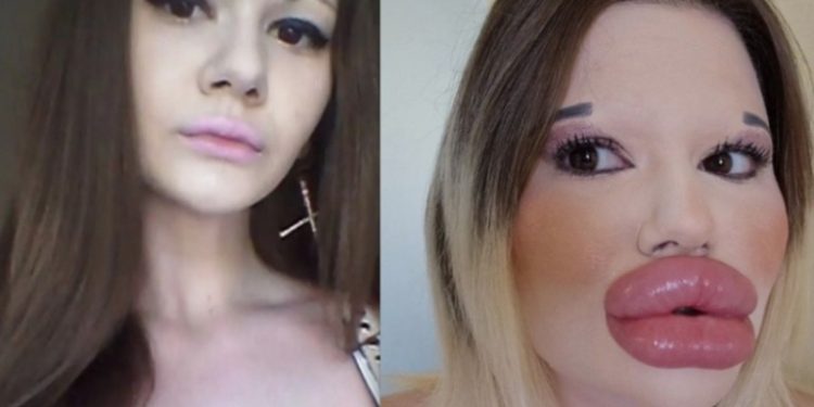 ‘Barbie humana’ corre risco de morrer após realizar preenchimento labial 32 vezes