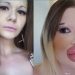 ‘Barbie humana’ corre risco de morrer após realizar preenchimento labial 32 vezes
