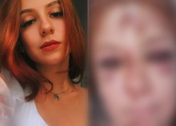 Jovem atropela onça e fica com rosto desfigurado após capacete se soltar